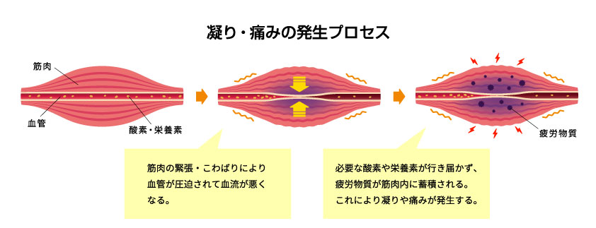 筋肉のコリ・痛みの発生プロセス